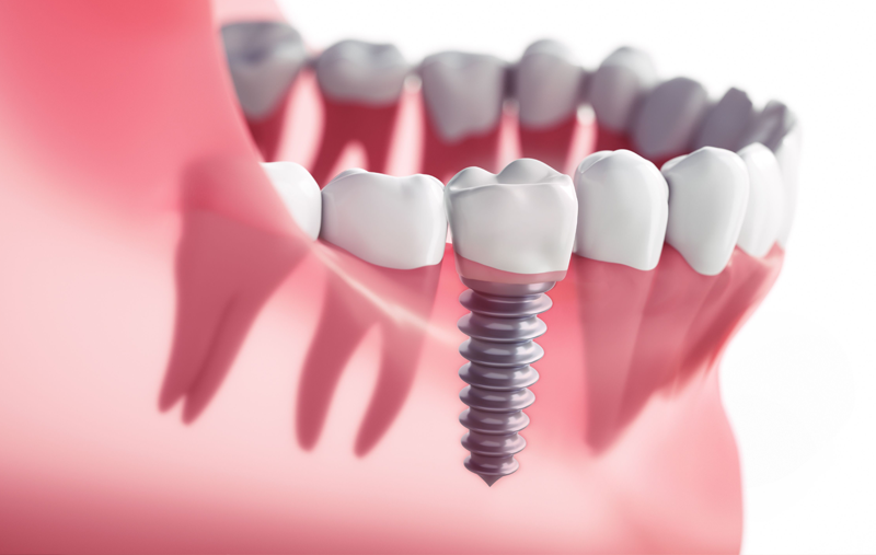 DENTAL IMPLANT
